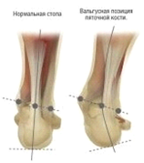 какой врач проверяет плоскостопие